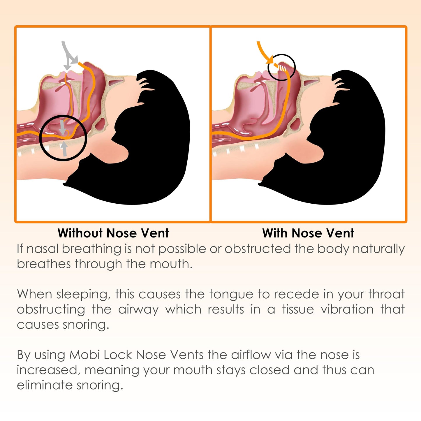 Nose Vent Sinus Relief (Pack of 12 Small Size) Soft Vents - A Simple Solution for Nasal Snorers - Reusable Snoring Device to Enjoy a Peaceful Night's Sleep - by Mobi Lock