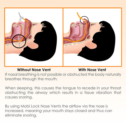 Nose Vent Sinus Relief (Pack of 12 Small Size) Soft Vents - A Simple Solution for Nasal Snorers - Reusable Snoring Device to Enjoy a Peaceful Night's Sleep - by Mobi Lock